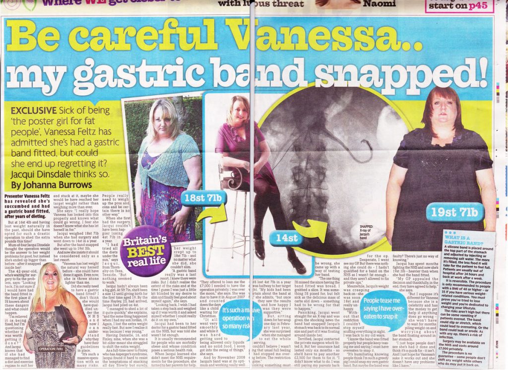 My Gastric Band Snapped!