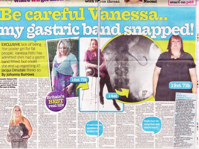 My Gastric Band Snapped!