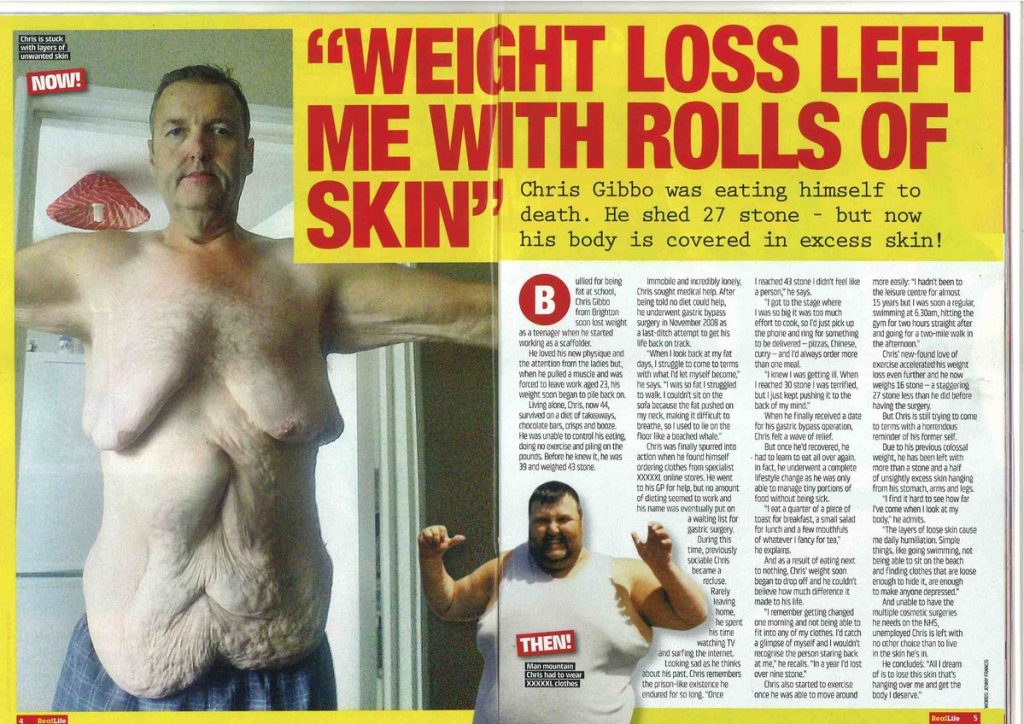 Weight loss left me with rolls of skin