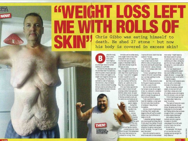 Weight loss left me with rolls of skin