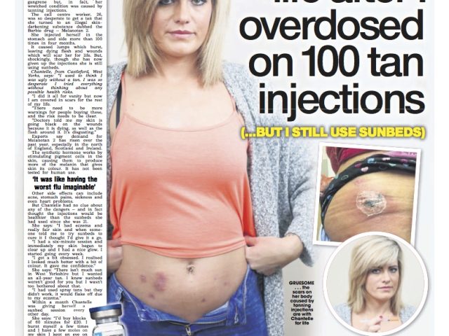 Tanning injections left me full of holes